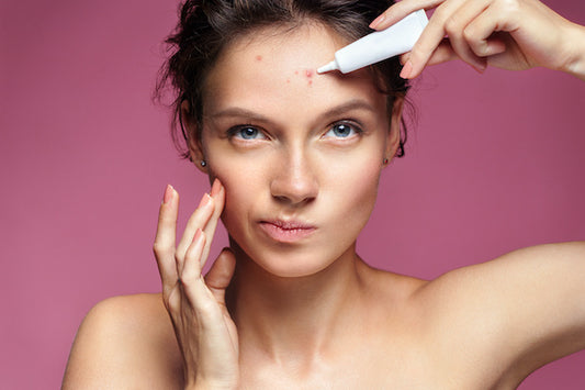 woman touching her cheek and applying white tube of skincare product to acne blemish on her forehead