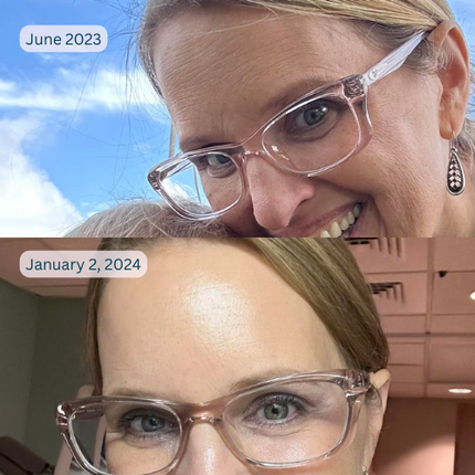split image of woman with glasses showing before image on top with forehead wrinkles and after image on bottom with smooth forehead from wearing frownies soft cotton forehead serum patch