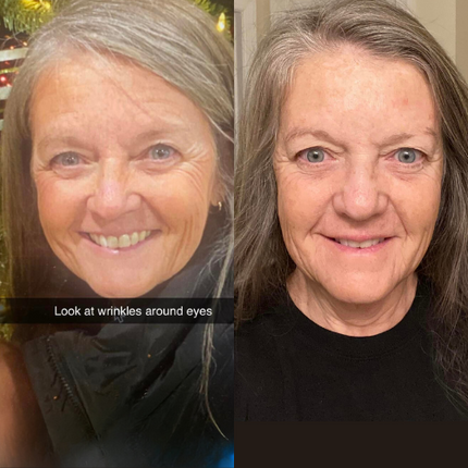 split image of woman with mature skin Before and after frownies for smooth forehead