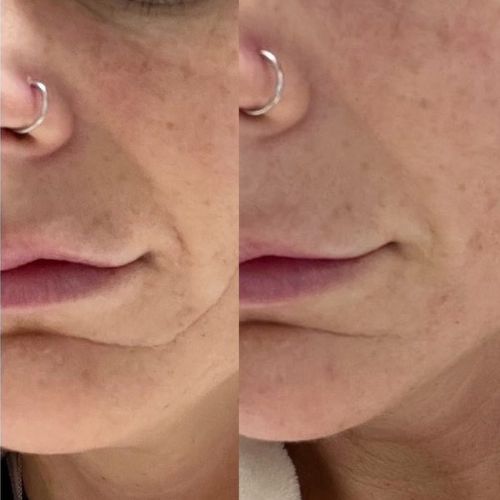 before and after for CEM facial patches