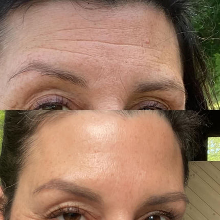 split image of woman's forehead Before and after frownies for horizontal forehead lines