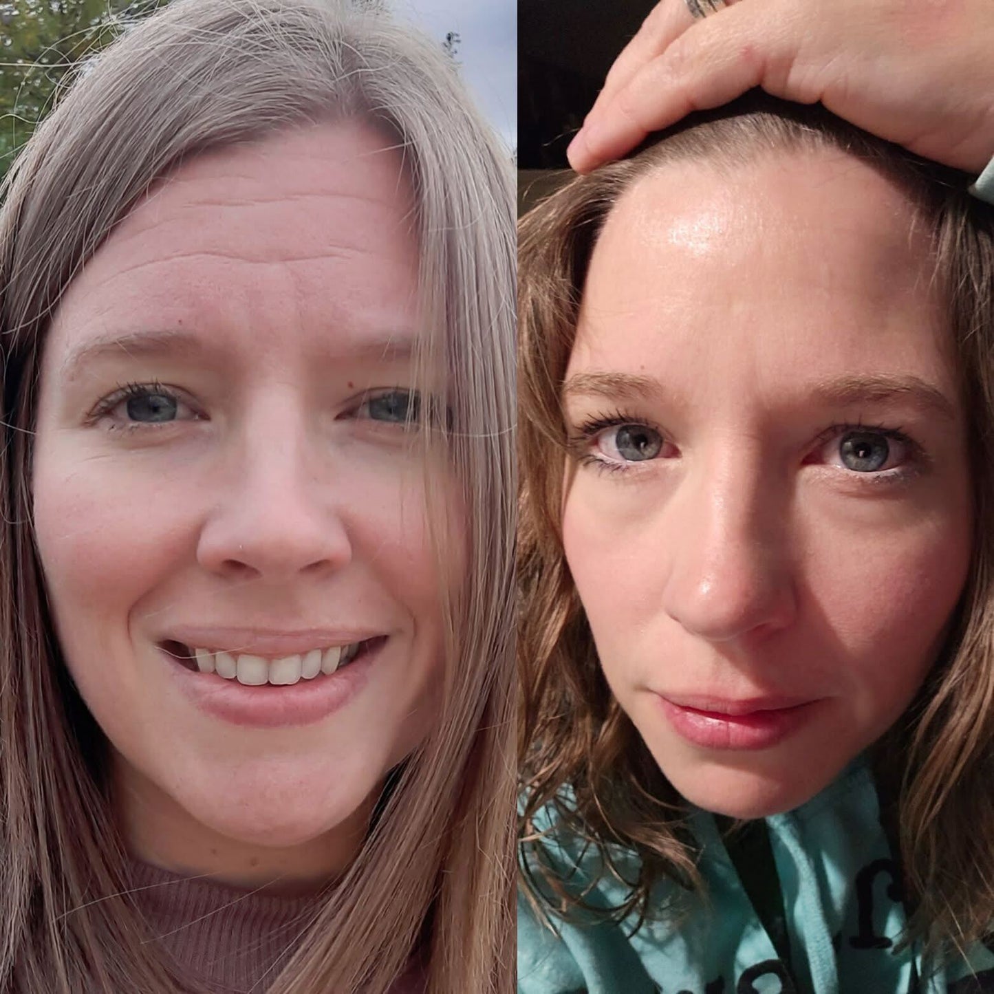 A before and after showing a customer who uses Frownies FBE facial patches , showing her improvement of her fine lines on the forehead