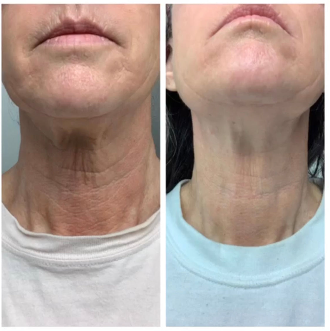 before and after of a customer who uses Frownies chin-up polypeptide mask