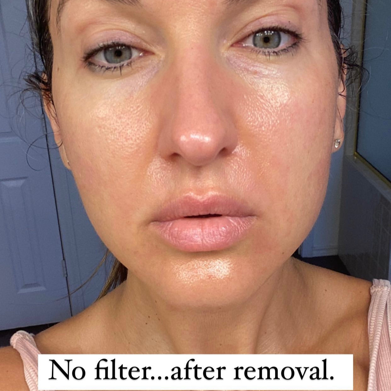 No filter after removal frownies gentle lifts