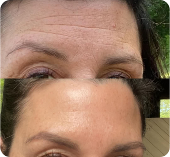 before and after pictures of a womans forehead after using wrinkle patches for deep forehead wrinkles