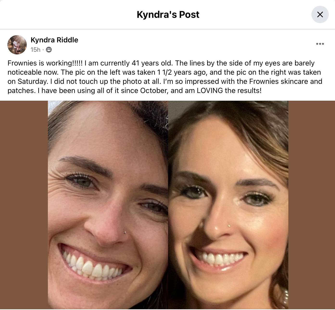 Frownies is working! 41 year old woman showing before and after pictures of her after using Frownies skincare patches