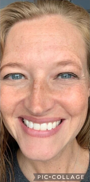 woman with strawberry blonde hair and freckles with smooth forehead after using frownies wrinkle patches