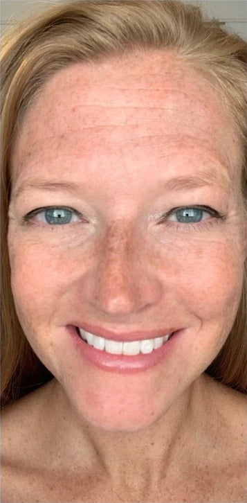 woman with strawberry blonde hair and freckles with forehead lines before using frownies wrinkle patches