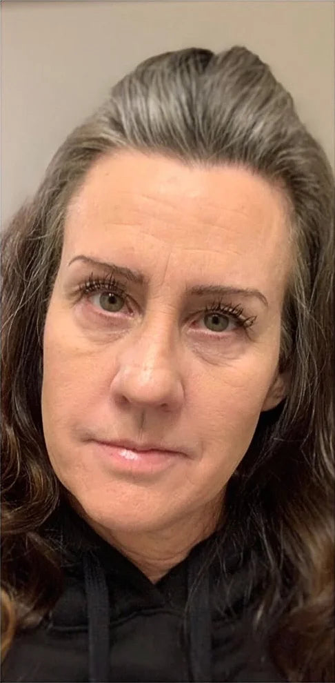 woman with mature skin and forehead wrinkles and 11 lines before using frownies facial patches