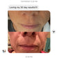 woman's mouth smile lines before and after Corners of Eyes & Mouth Wrinkle Patches Facial Patches Frownies   
