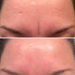 before and after Forehead & Between Eyes Wrinkle Patches Facial Patches Frownies to smooth 11 lines