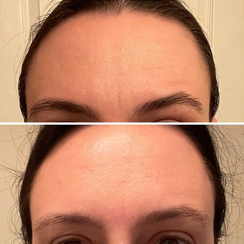 woman's forehead before and after using Forehead & Between Eyes Wrinkle Patches Facial Patches Frownies   