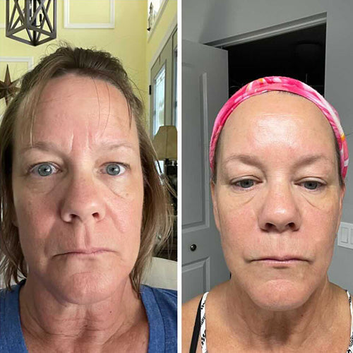 woman with mature skin before and after using Forehead & Between Eyes Wrinkle Patches Facial Patches Frownies to smooth 11 lines   
