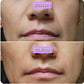 woman's mouth smile lines before and after using Corners of Eyes & Mouth Wrinkle Patches Facial Patches Frownies   