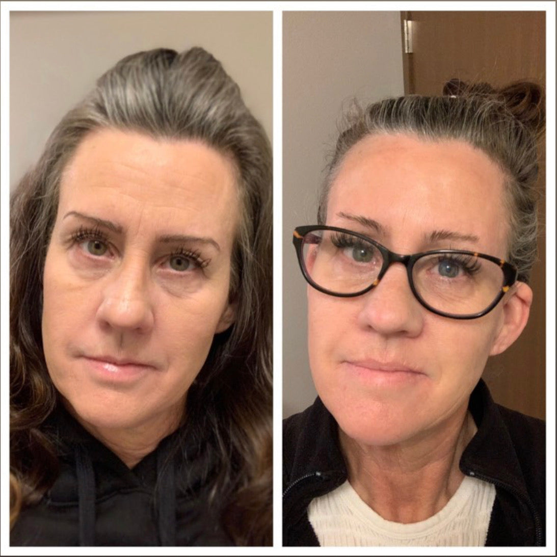 woman's before and after woman wearing Forehead & Between Eyes Wrinkle Patches to smooth forehead wrinkles Facial Patches Frownies   