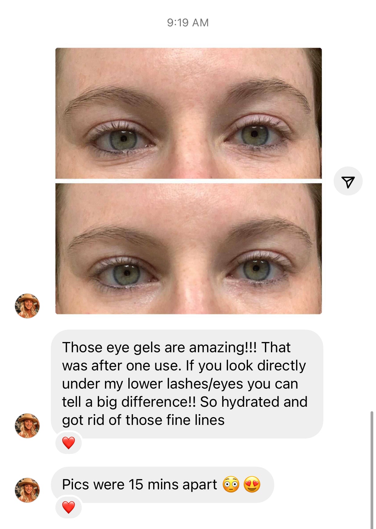 before and after of woman's eye using Cactus Collagen Under Eye Gels Facial Patches Frownies   