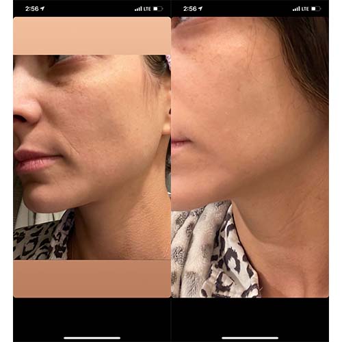 woman's smile lines before and after Corners of Eyes & Mouth Wrinkle Patches Facial Patches Frownies   