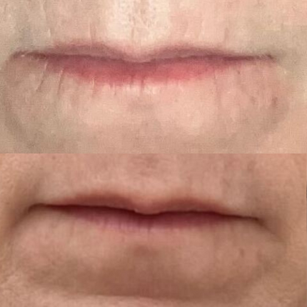 split image of lips Before and after using frownies for lip wrinkles and smokers lines