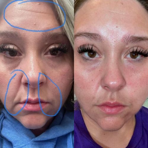 Eye Mouth Wrinkle Patches Natural Botox Alternative