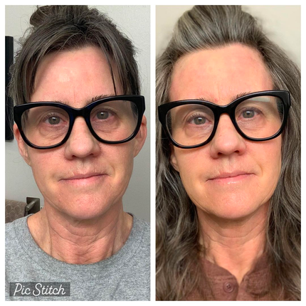 side by side images of woman's face wearing black rimmed glasses, before image on the left showing crepey skin on the neck, after picture on the left following consistent use of frownies chin-up to smooth neck wrinkles