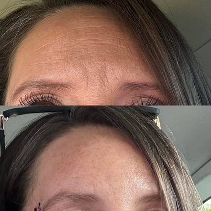 before and after womans forehead after using frownies forehead serum patch for deep hydration