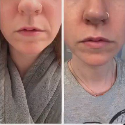 split image of woman's lower face Before and after frownies wrinkle patches for smile lines