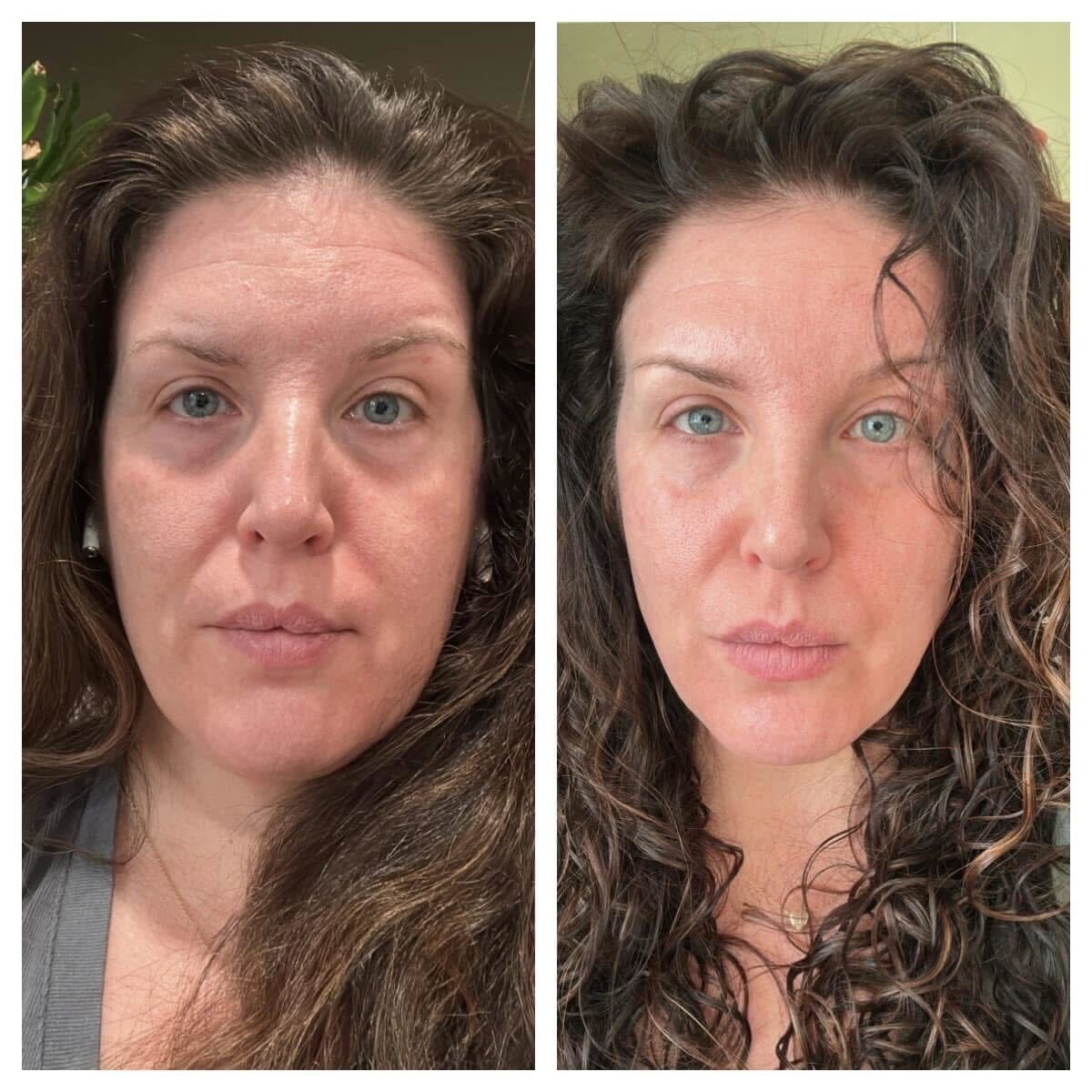 Forehead Wrinkle Patches Forehead Frown Line Solution