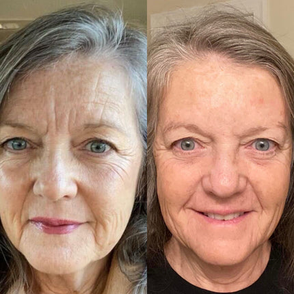 split image of woman with mature skin Before and after frownies wrinkle patches for deep forehead lines