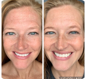 before and after results of frownies facial patches of a woman with blue eyes and freckles