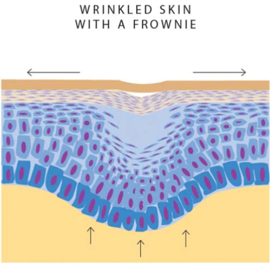 infographic showing how frownies improve wrinkled skin
