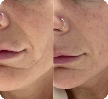side by side of same woman's face showing before and after of wrinkled skin near corner of the mouth