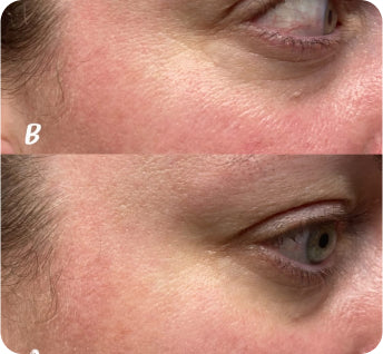 split photo of woman's cheek and eye area before and after using frownies facial patches for crows feet
