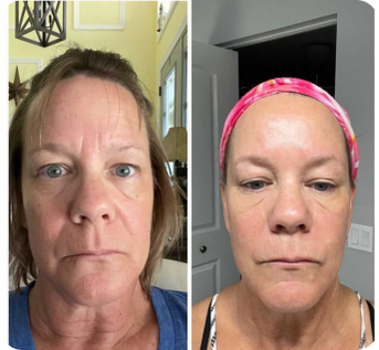 before and after of a woman not smiling showing reduced wrinkles after using frownies wrinkle patches