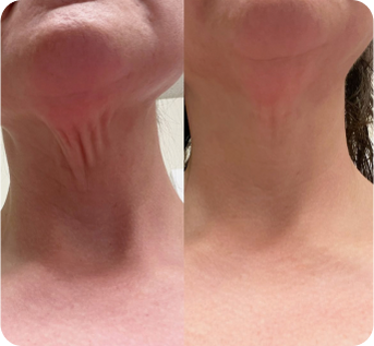 before_and_after_neck_mask_results