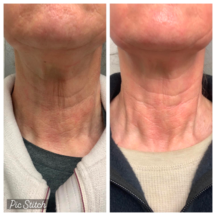 side by side images of close up of woman's neck, before image on left, after image on right showing smoothed turkey neck following consistent use of frownies chin-up copper peptide mask