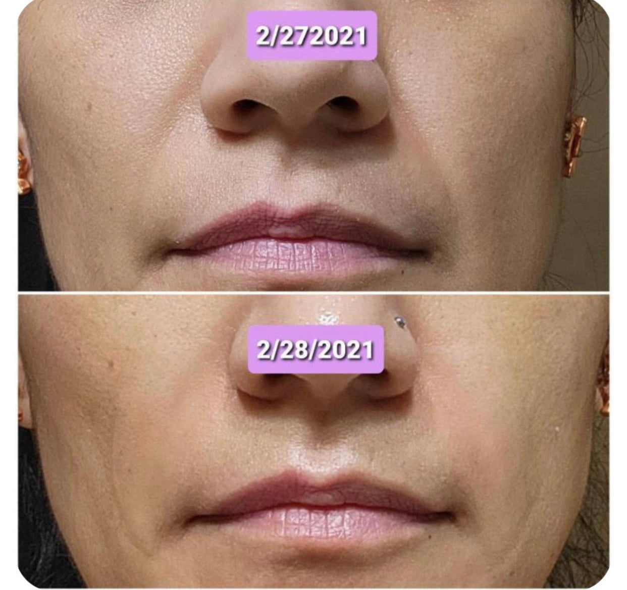 Lower half of a woman's face that has the date 2/27/2021 and another image that has the date 2/28/2021 shows improvement after one day using Frownies Facial Patch for wrinkles on the corner of the mouth