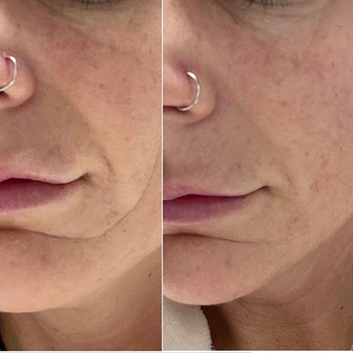 lower half of the left side of a woman's face showing winkle lines and improvement after using frownies facial patch 